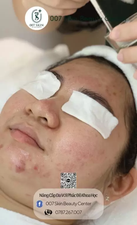 3 MED TCA Peel