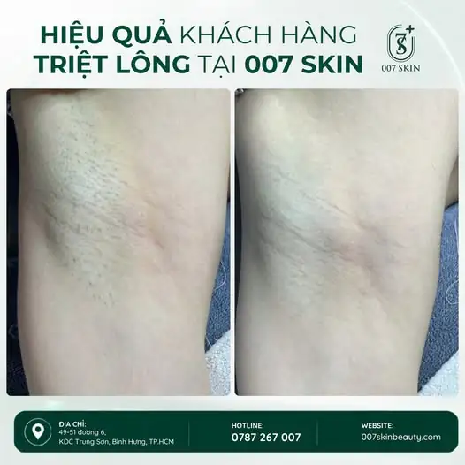 AI NÊN TRIỆT LÔNG NÁCH?