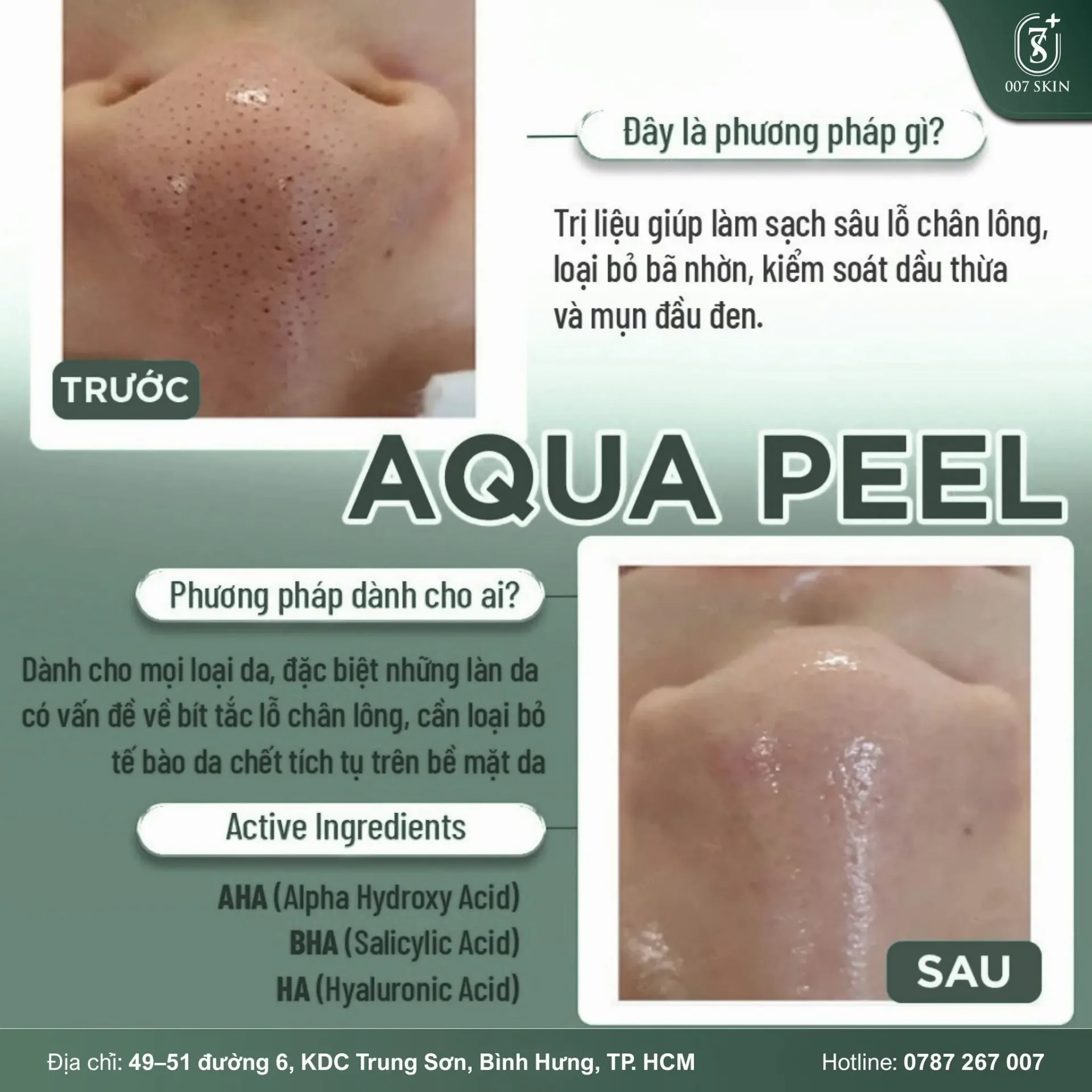 AQUA PEEL – LÀM SẠCH SÂU, DA MỊN THẤY RÕ CHỈ SAU 1 BUỔI