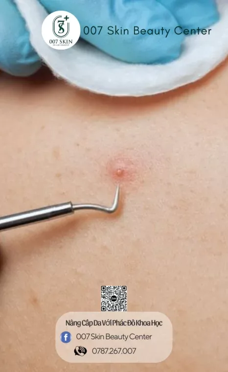 BACK ACNES REMOVAL (NẶN MỤN LƯNG)