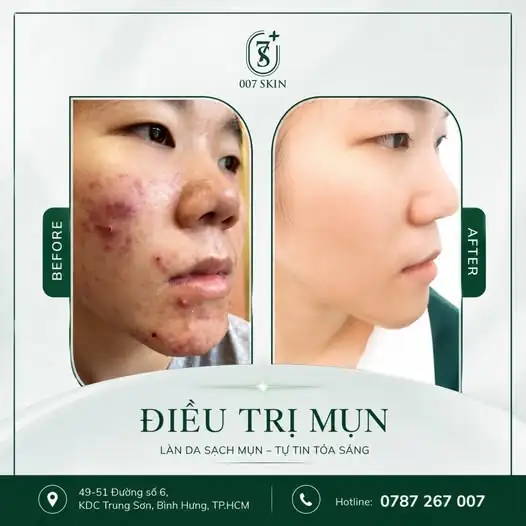 BIẾN HÓA LÀN DA: TỪ MỤN VIÊM NẶNG ĐẾN SẠCH MỤN TỰ TIN! 🔥