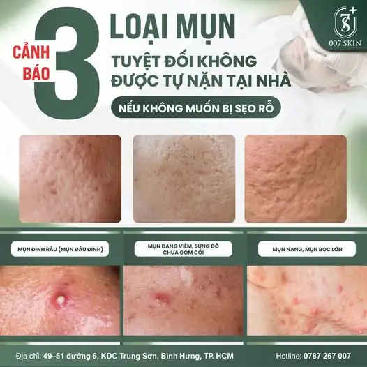 CẢNH BÁO: 3 LOẠI MỤN TUYỆT ĐỐI KHÔNG NÊN TỰ NẶN TẠI NHÀ