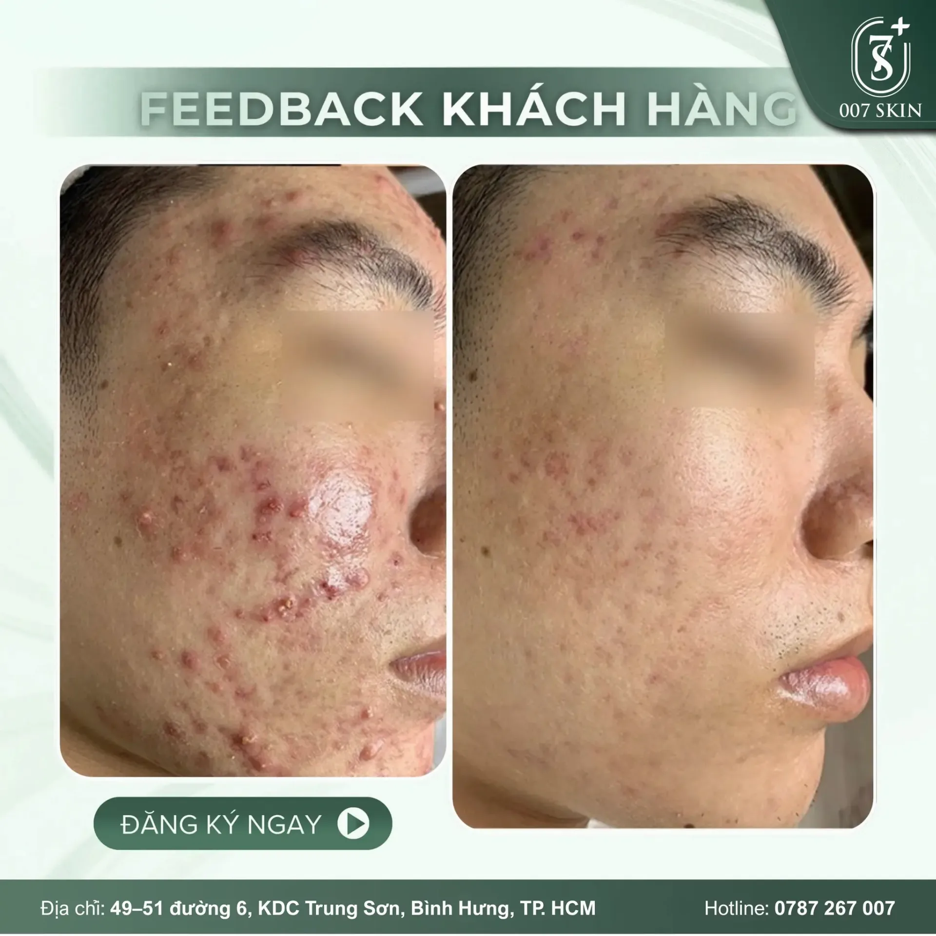 CHẤM DỨT NỖI LO MỤN VIÊM