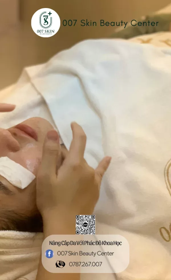 CHEMICAL PEEL DA NHẠY CẢM