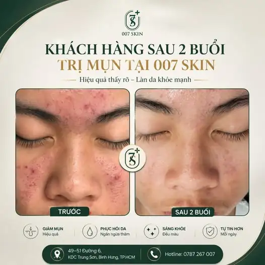 CHỈ SAU 2 BUỔI – LÀN DA ĐÃ THAY ĐỔI RÕ RỆT! ✨