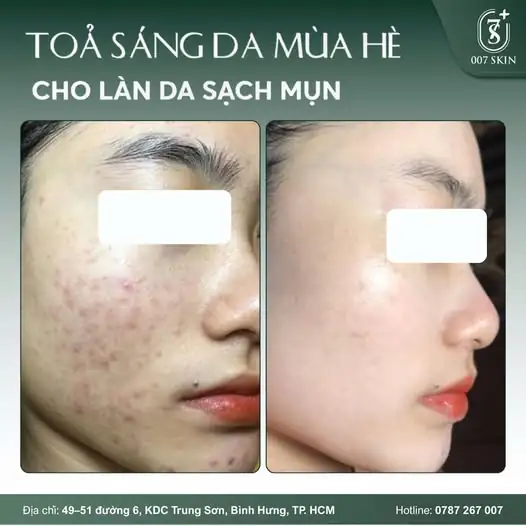 DA CĂNG BÓNG, SẠCH MỤN – "LỘT XÁC" DIỆN MẠO ĐÓN HÈ! ☀️