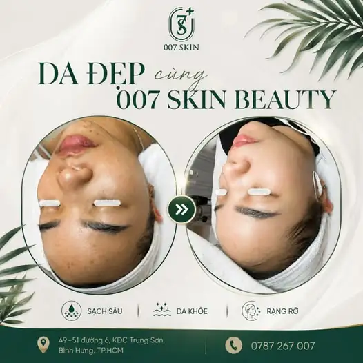 DA ĐẸP MỖI NGÀY CÙNG 007 SKIN BEAUTY – KẾT QUẢ THAY ĐỔI RÕ RỆT!