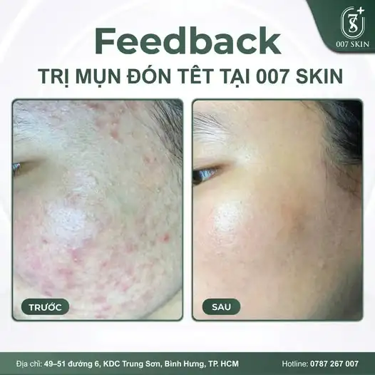 DA ĐẸP - TỰ TIN DU XUÂN CÙNG 007 SKIN! 🌸