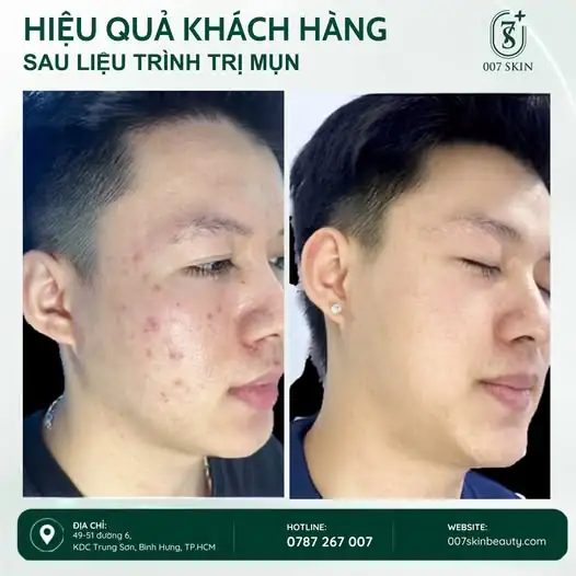 DA KHÔNG CÒN LÀ NỖI LO KHI MỤN ĐƯỢC XỬ LÝ ĐÚNG CÁCH! ✨
