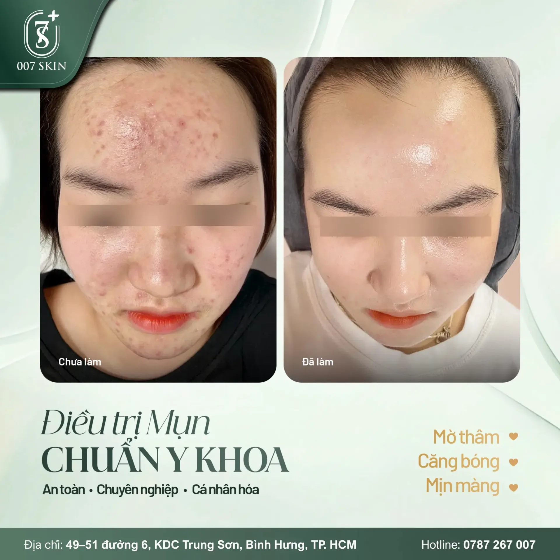 Da mụn không phải lỗi của bạn – chọn đúng nơi điều trị mới là chìa khóa!