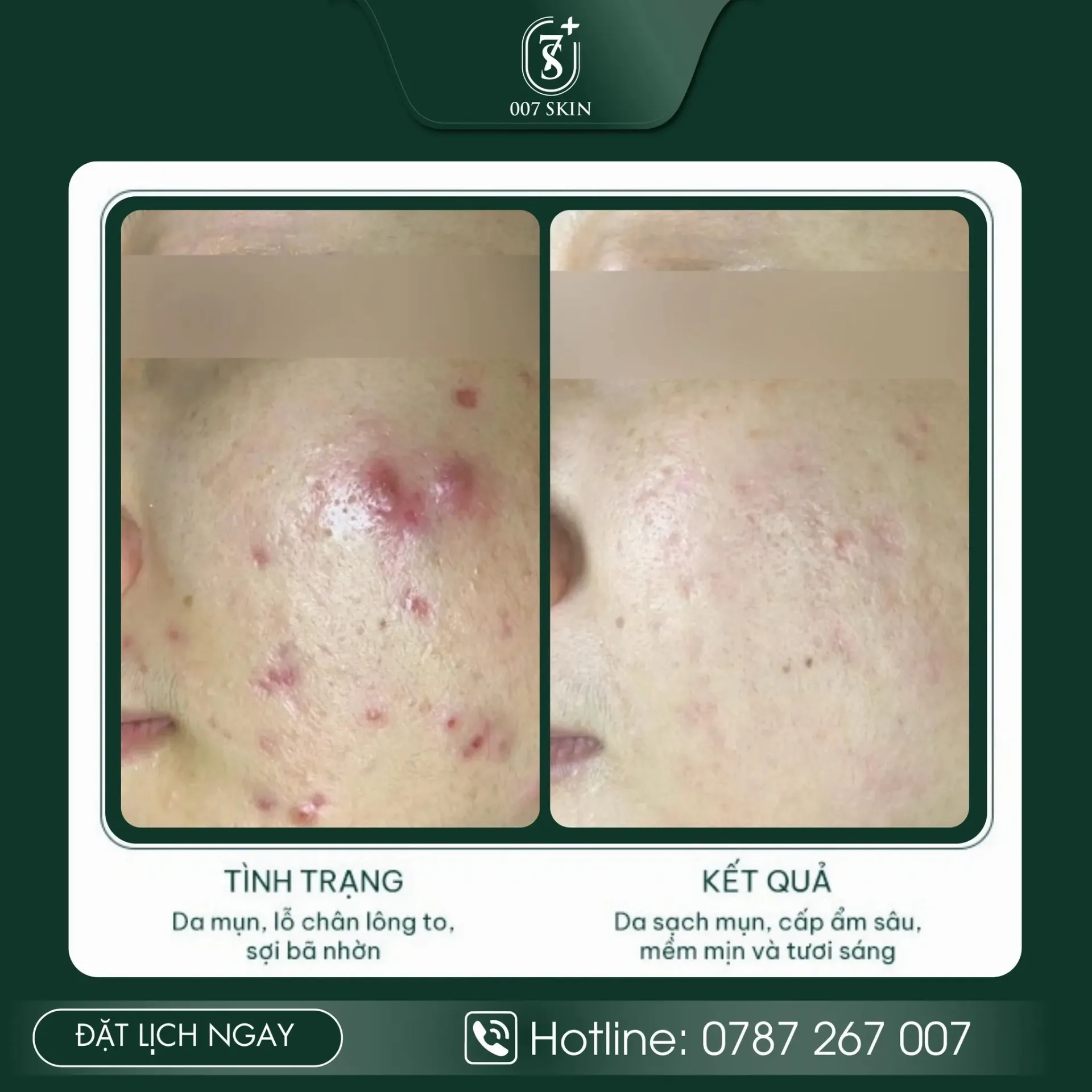 DA MỤN NẶNG – GIỜ ĐÂY ĐÃ SẠCH MỊN & TƯƠI SÁNG HƠN RÕ RỆT