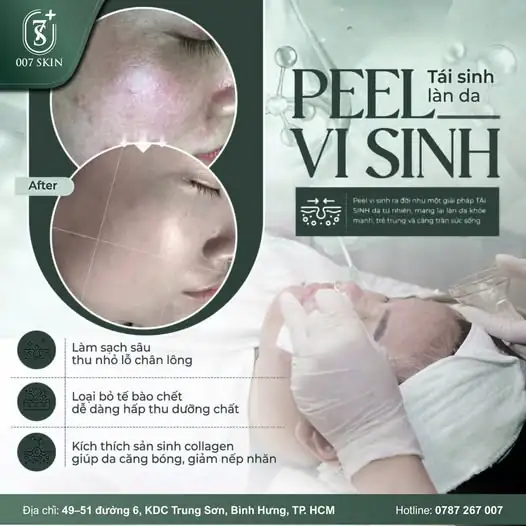 DA MỤN, THÂM SẠM KHÔNG CÒN LÀ NỖI LO – TÁI SINH LÀN DA CHỈ SAU 1 LIỆU TRÌNH PEEL VI SINH ✨