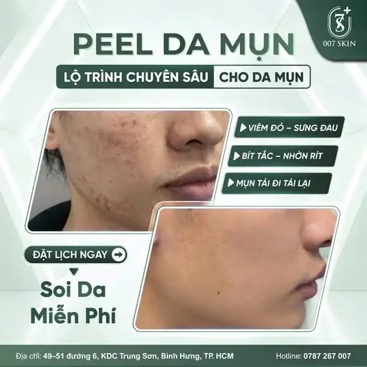 DA SẠCH MỤN – LẤY LẠI PHONG ĐỘ CHỈ SAU MỘT LIỆU TRÌNH