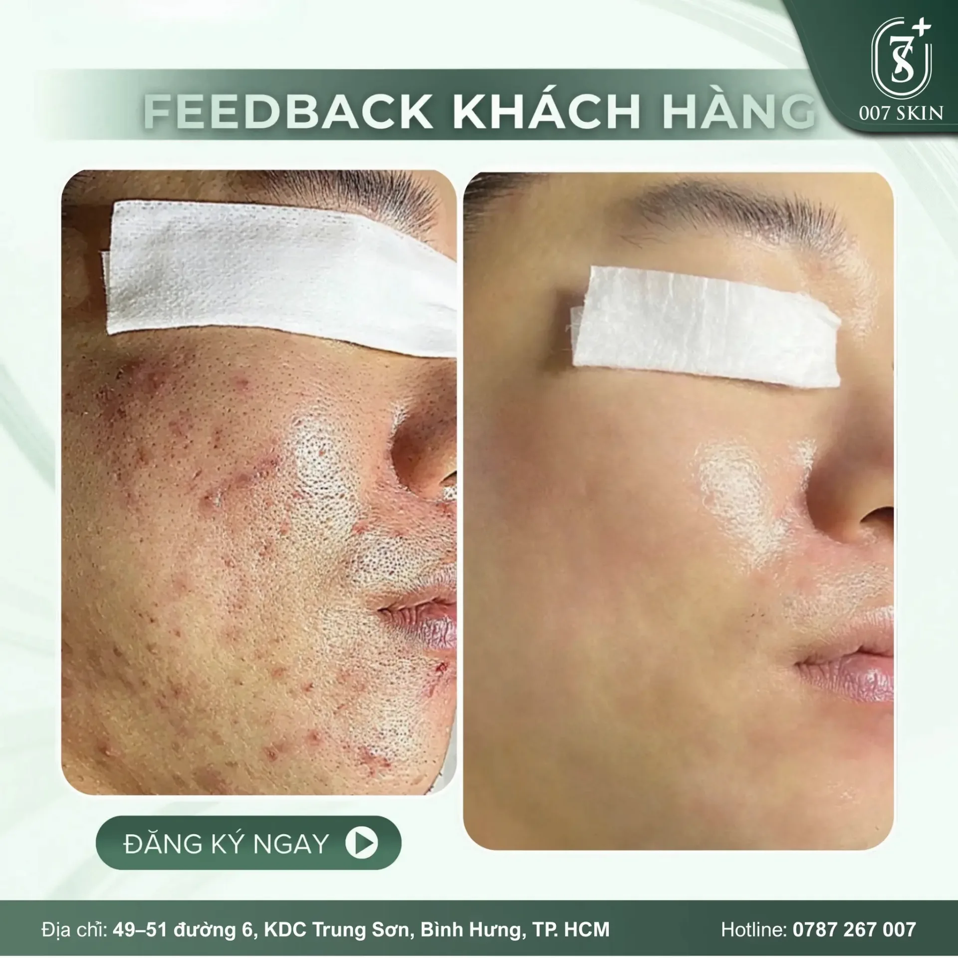 DA SẠCH MỤN - MỊN LỖ CHÂN LÔNG: CẢI THIỆN 90% CHỈ SAU 1 LIỆU TRÌNH