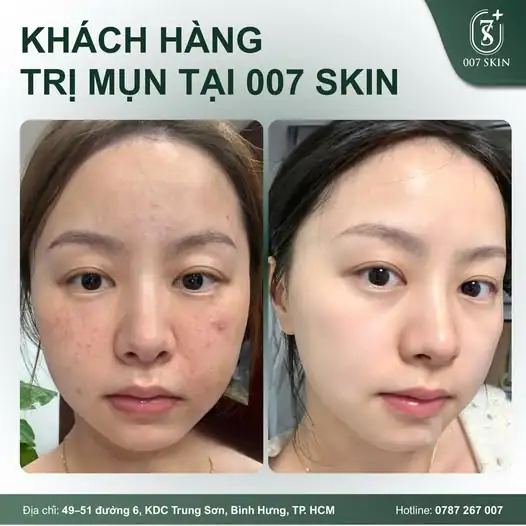 DA SẠCH MỤN – TỰ TIN KHOE DIỆN MẠO RẠNG NGỜI ✨