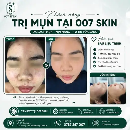 DA SẠCH MỤN - TỰ TIN TỎA SÁNG CÙNG 007 SKIN ✨💖