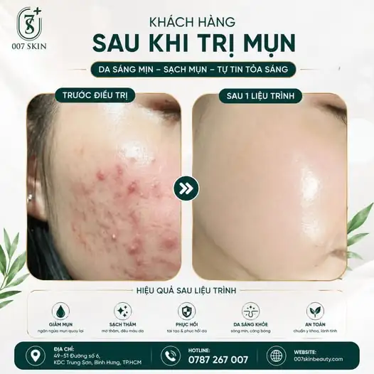 DA SÁNG MỊN – SẠCH MỤN – TỰ TIN TỎA SÁNG! ✨