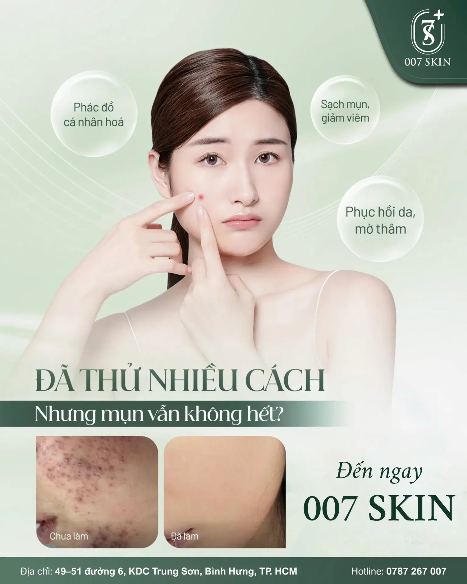ĐÃ THỬ NHIỀU CÁCH – NHƯNG MỤN VẪN KHÔNG HẾT? Có thể bạn đang thiếu một lộ trình điều trị đúng và phù hợp với làn da của mình!
