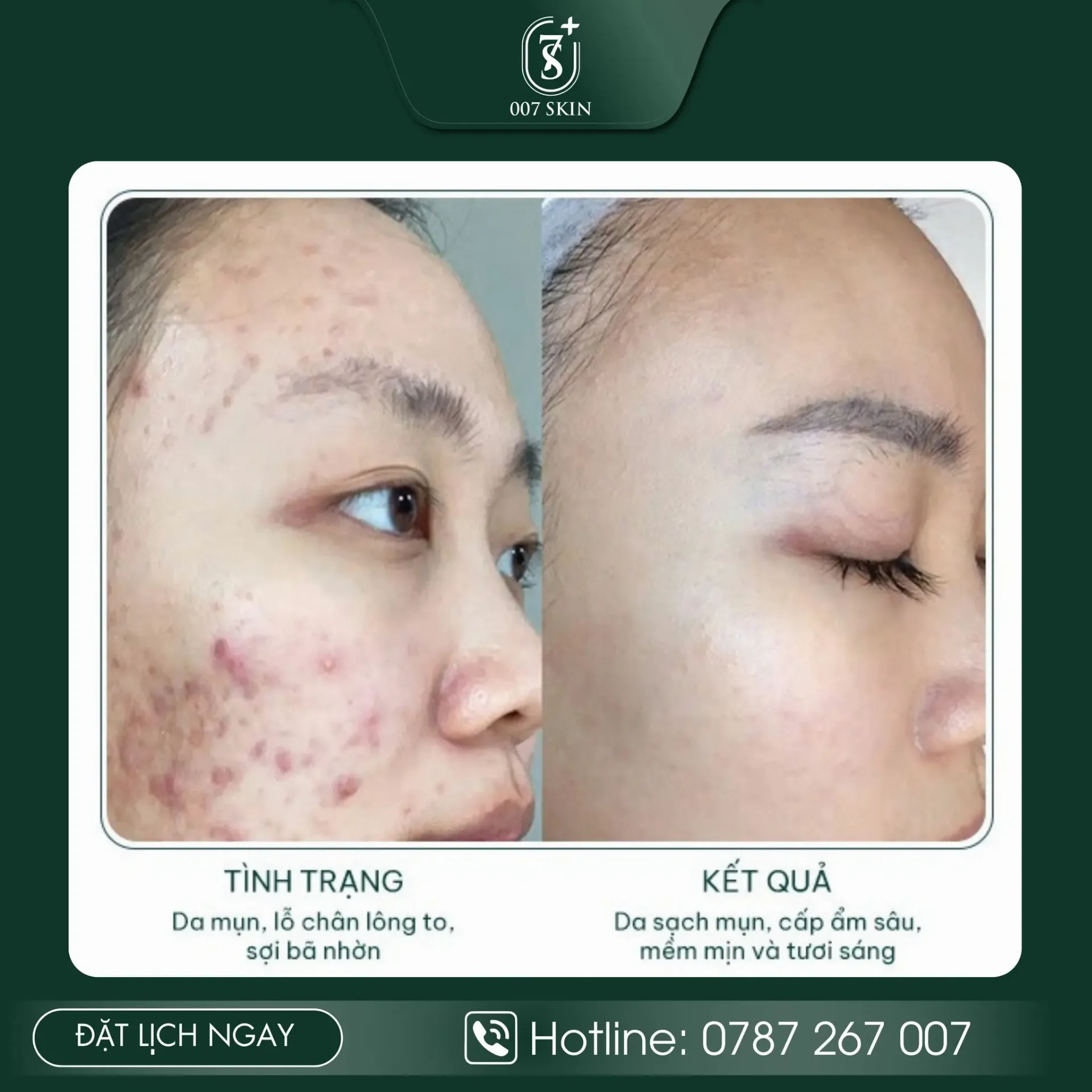 DA XUỐNG CẤP VÌ MỤN – 007 SKIN GIÚP BẠN “L.ỘT X.ÁC”