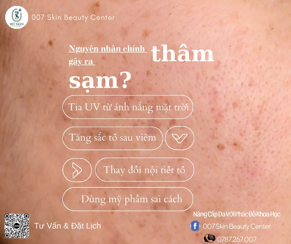 Đánh Bay Mụn Viêm Hiệu Quả Tại 007 Skin Center: Liệu Trình Chuyên Sâu Từ Chuyên Gia