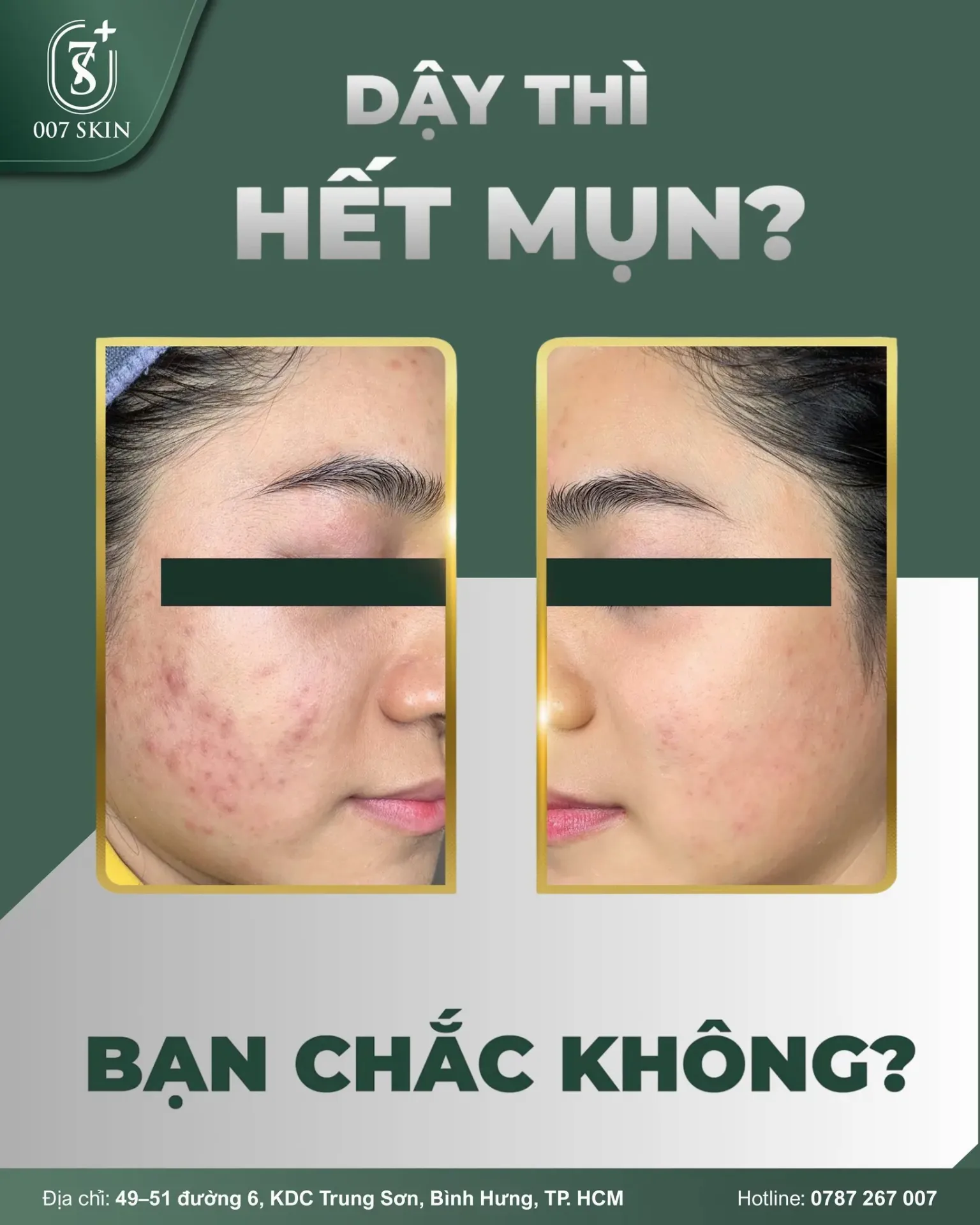 Dậy Thì Hết Mụn? Đừng Mơ! Sự Thật Phũ Phàng Về Mụn Tuổi Dậy Thì