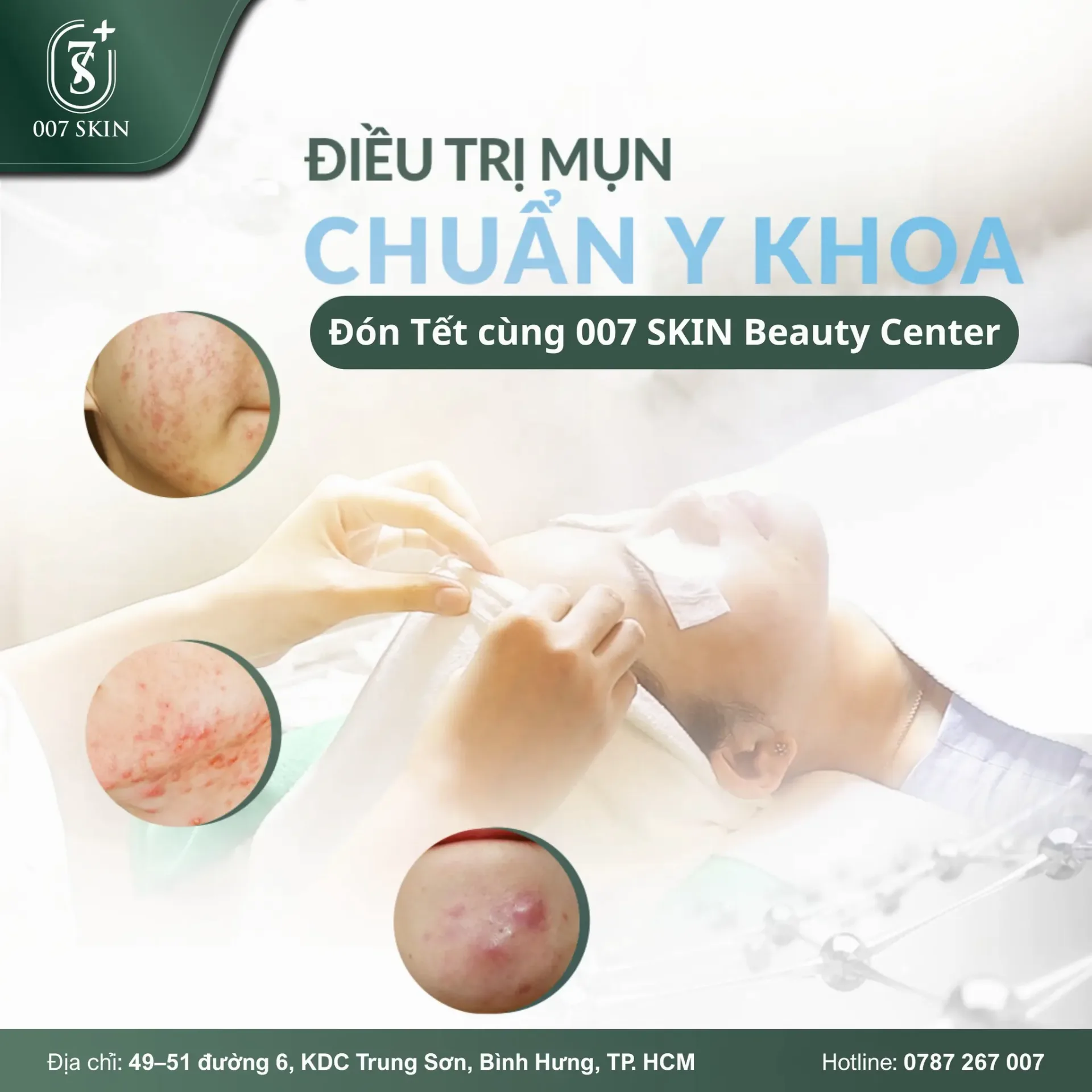 ĐIỀU TRỊ MỤN CHUẨN Y KHOA – TỰ TIN ĐÓN TẾT CÙNG 007 SKIN