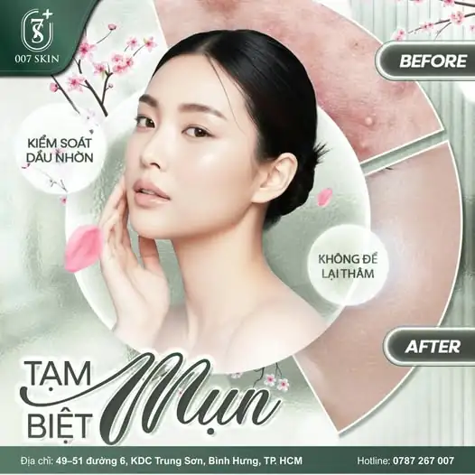 ĐỪNG ĐỂ MỤN LÀM BẠN MẤT TỰ TIN – TẠM BIỆT MỤN NGAY HÔM NAY!