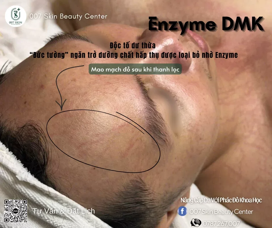 Enzyme DMK - Liệu Pháp Tại 007 Skin Beauty Khai Thông Tắc Nghẽn Cho Làn Da