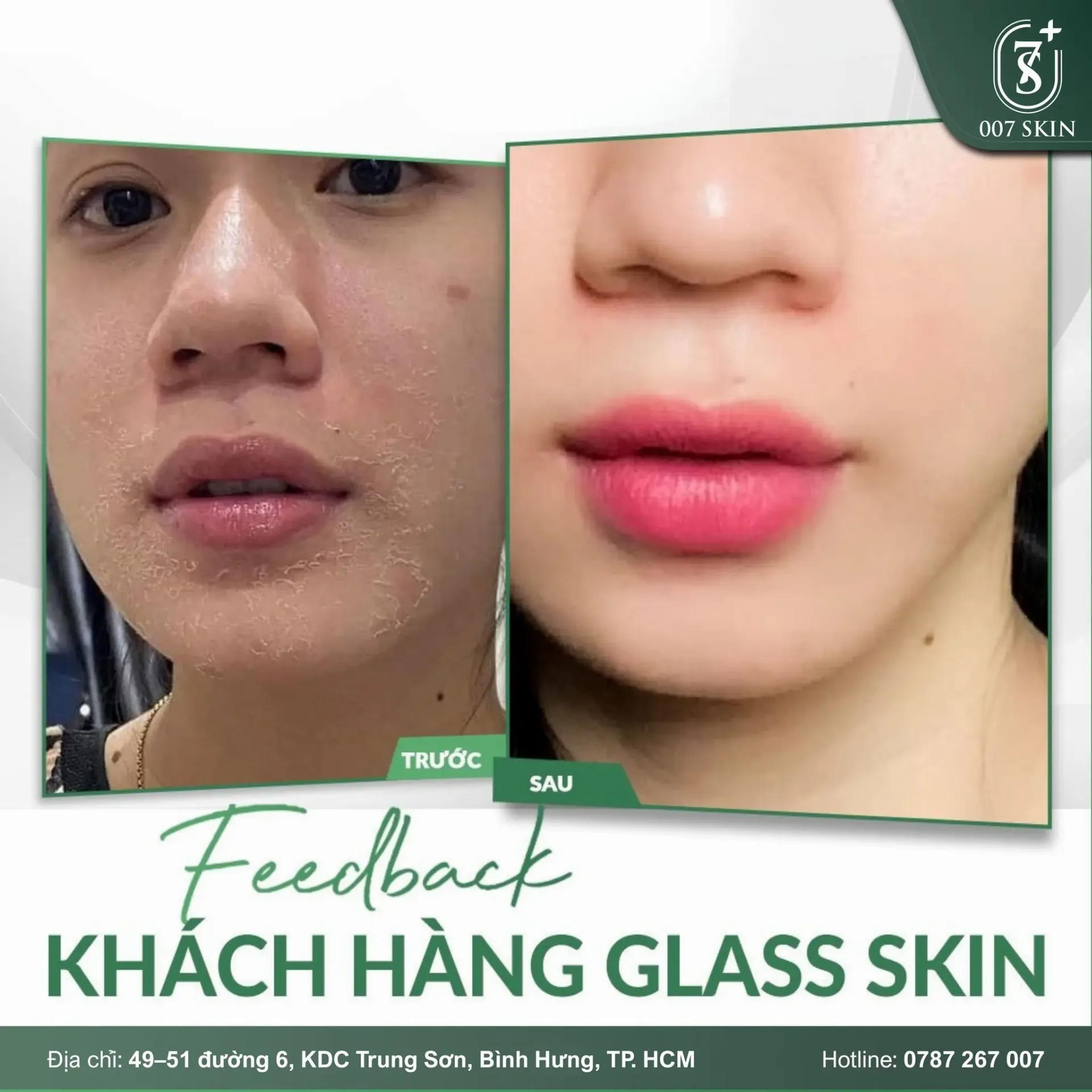 FEEDBACK KHÁCH HÀNG GLASS SKIN TẠI 007 SKIN