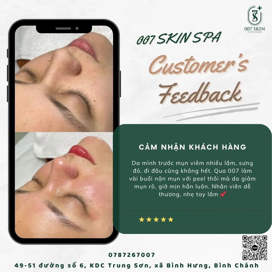 Feedback Khách Hàng Mụn: Bí Quyết Thành Công & Chia Sẻ Thực Tế