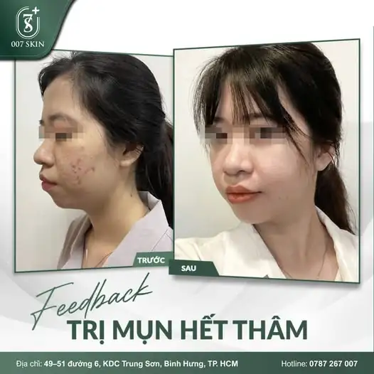FEEDBACK KHÁCH HÀNG – TRỊ MỤN HẾT THÂM TẠI 007 SKIN
