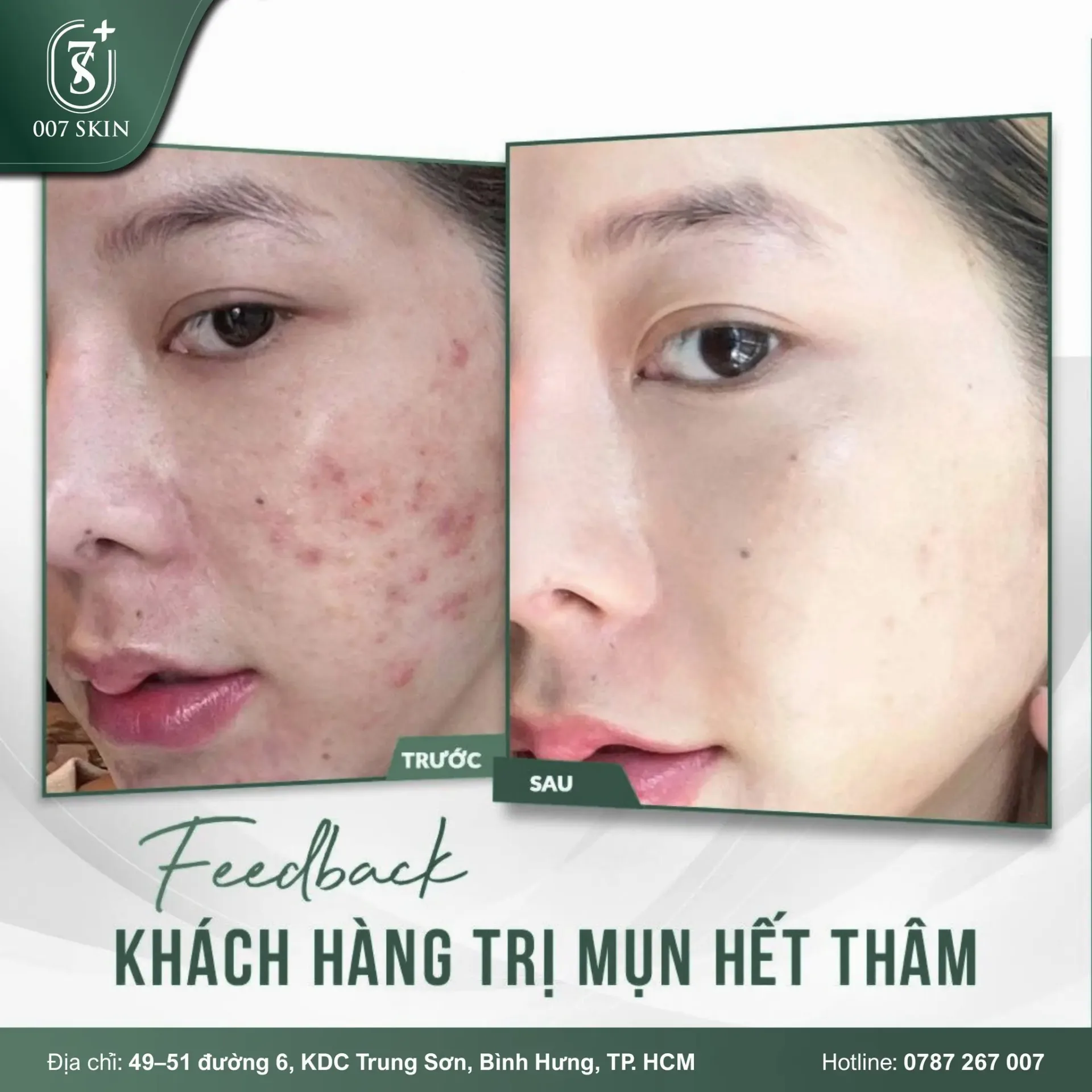 FEEDBACK KHÁCH HÀNG TRỊ MỤN – MỜ THÂM TẠI 007 SKIN