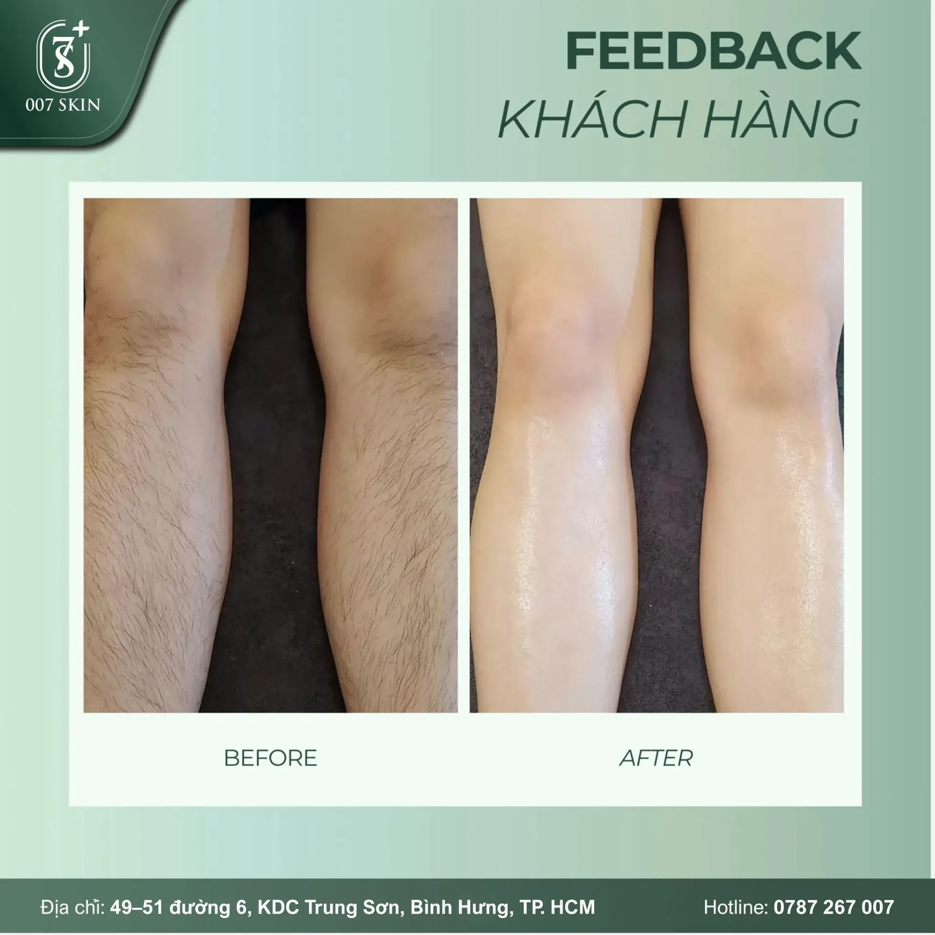FEEDBACK KHÁCH HÀNG TRIỆT LÔNG CHÂN TẠI 007 SKIN ✨