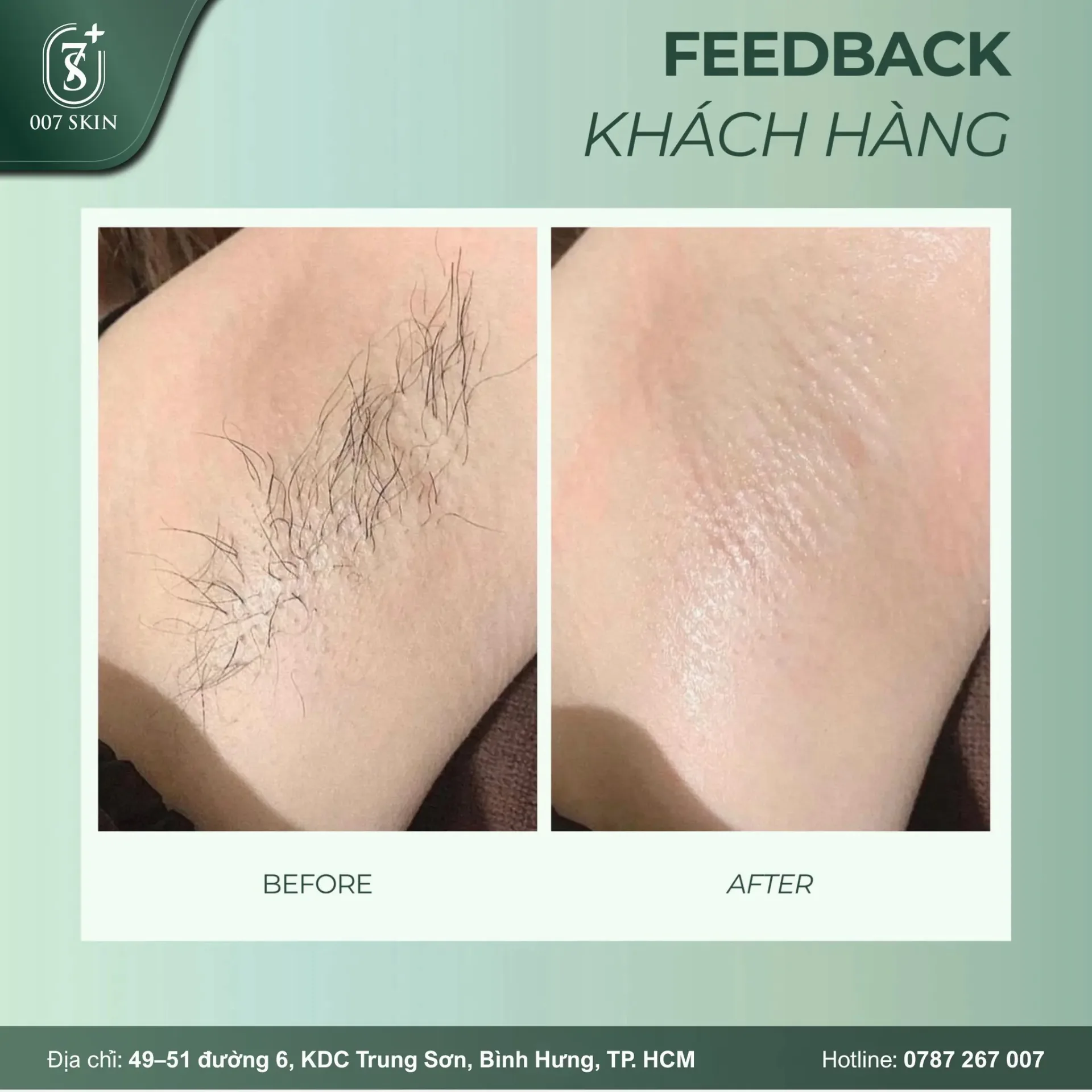 FEEDBACK KHÁCH HÀNG TRIỆT LÔNG TẠI 007 SKIN ✨