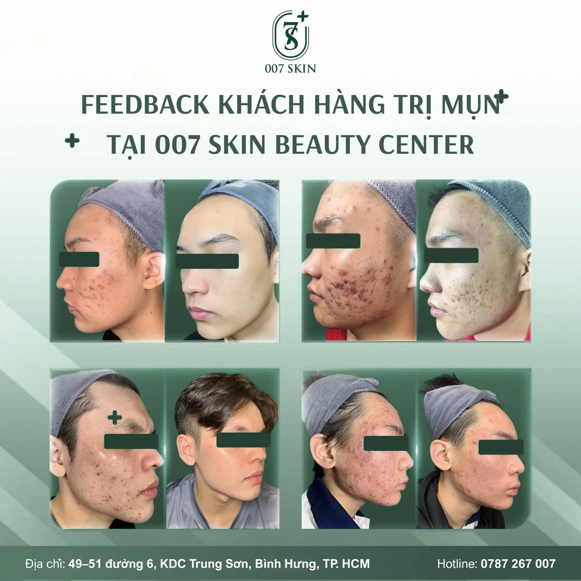 FEEDBACK TRỊ MỤN THỰC TẾ TẠI 007 SKIN BEAUTY CENTER