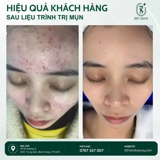 HÀNH TRÌNH CẢI THIỆN LÀN DA SAU LIỆU TRÌNH TRỊ MỤN ✨