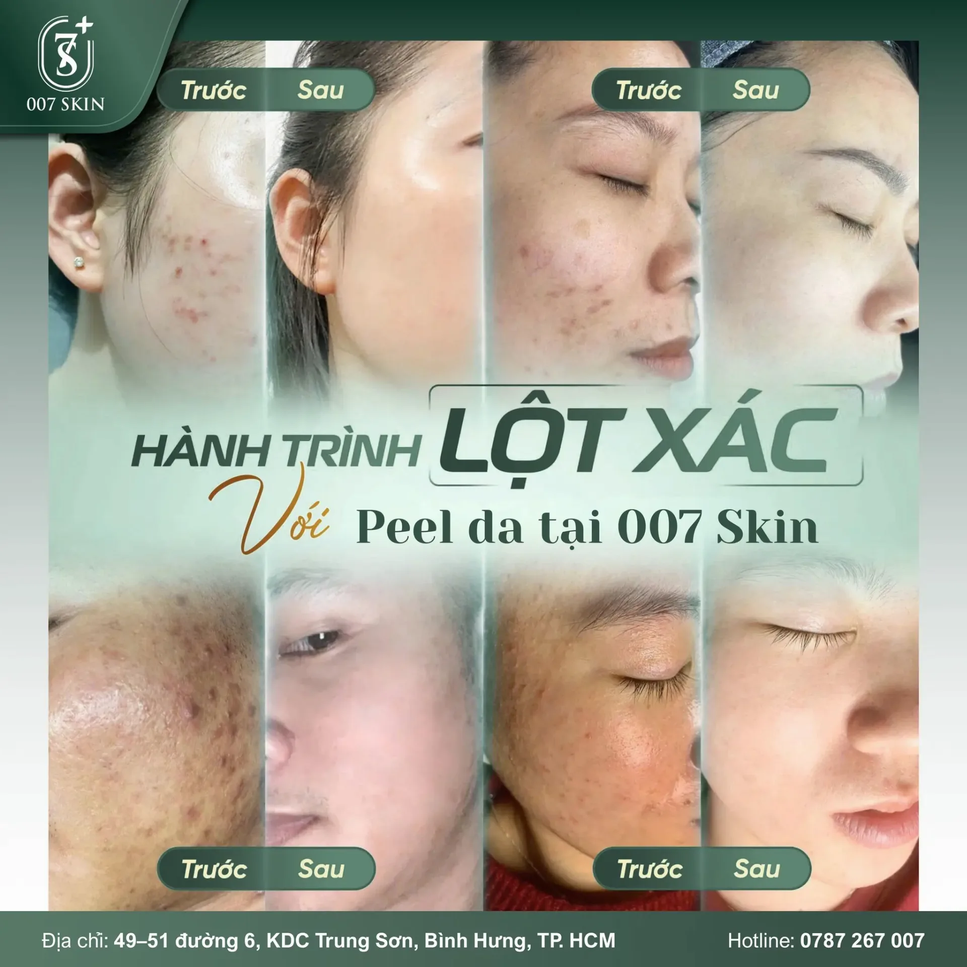 HÀNH TRÌNH “LỘT XÁC” LÀN DA – PEEL DA TẠI 007 SKIN