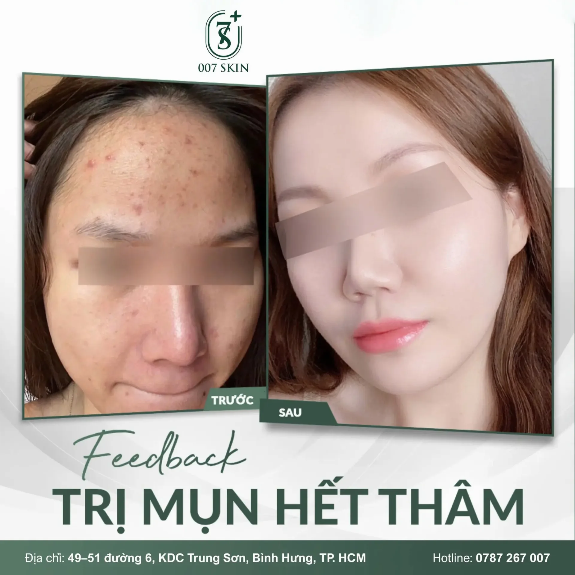 FEEDBACK THẬT – HIỆU QUẢ THẬT TẠI 007 SKIN
