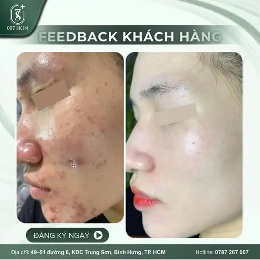 HÀNH TRÌNH TÌM LẠI LÀN DA CĂNG BÓNG – KẾT QUẢ THAY ĐỔI NGOẠI MỤC! ✨
