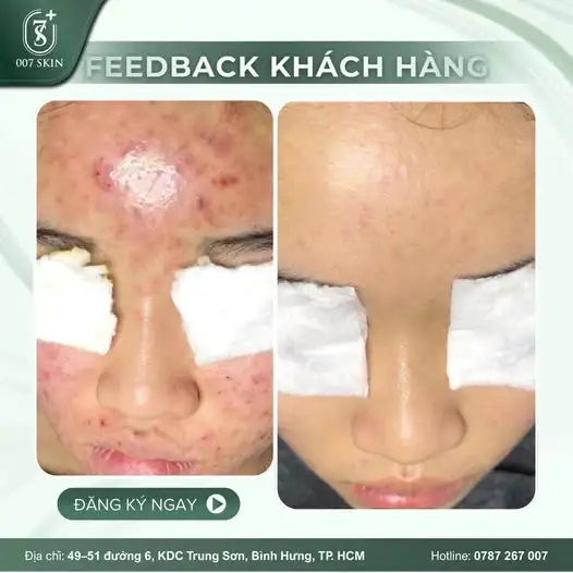 HẾT ÁM ẢNH MỤN VIÊM – "HỒI SINH" LÀN DA MỚI