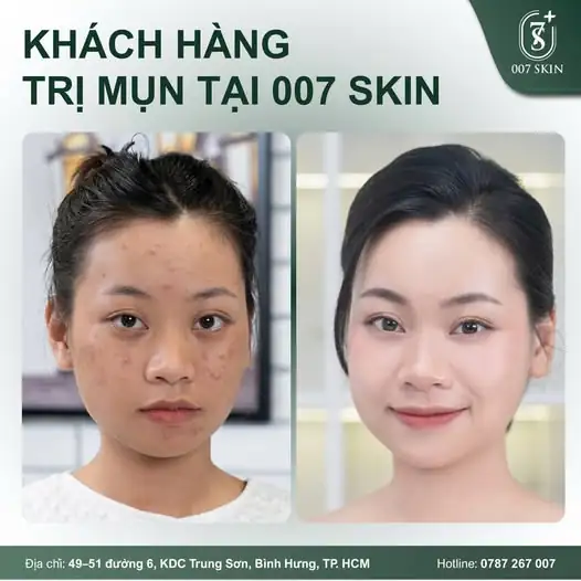 HẾT MỤN, HẾT LO – DA SÁNG MỊN MÀNG 🌿