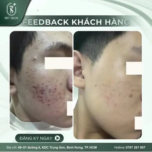 HẾT MỤN – MỜ THÂM – TỰ TIN KHOE DIỆN MẠO MỚI CÙNG 007 SKIN ✨