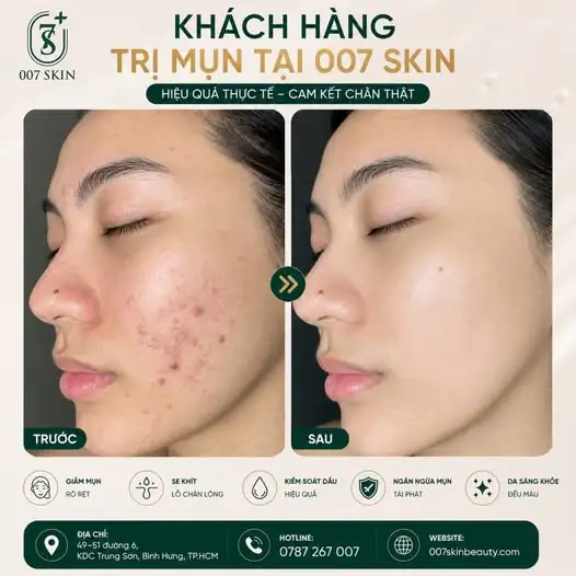 HẾT MỤN THÂM, TỰ TIN GÓC NGHIÊNG THẦN THÁNH! ✨