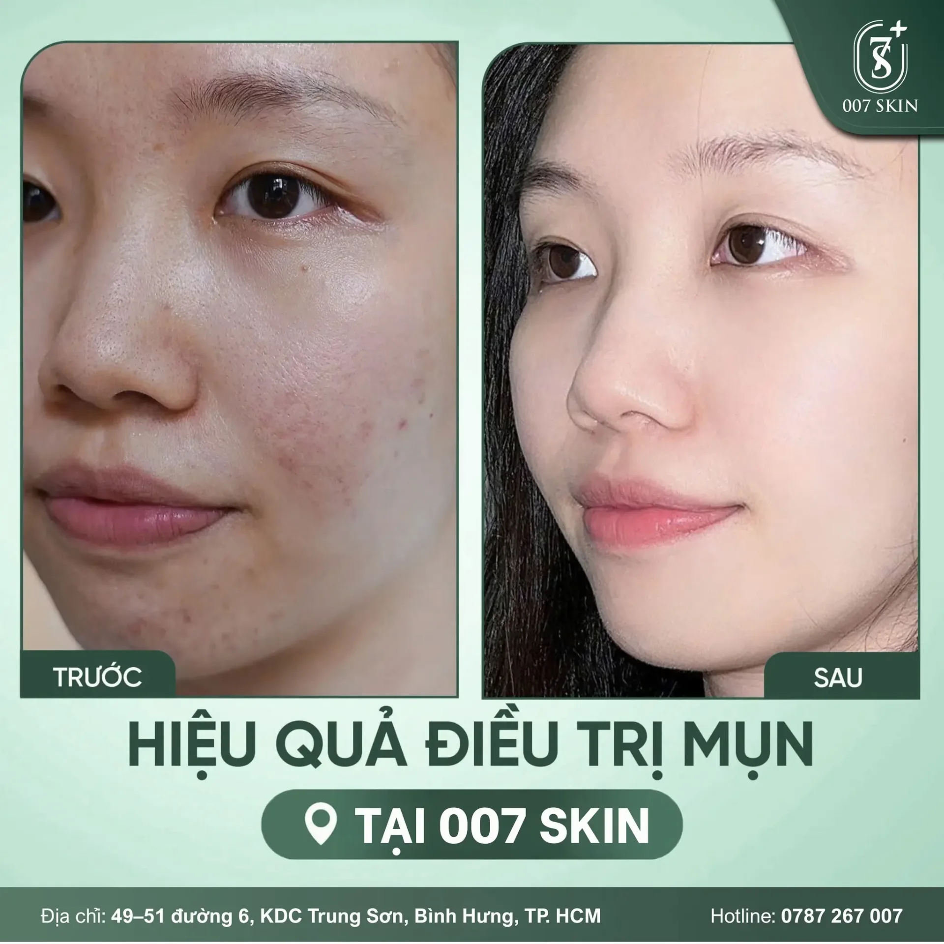 HIỆU QUẢ ĐIỀU TRỊ MỤN THỰC TẾ TẠI 007 SKIN