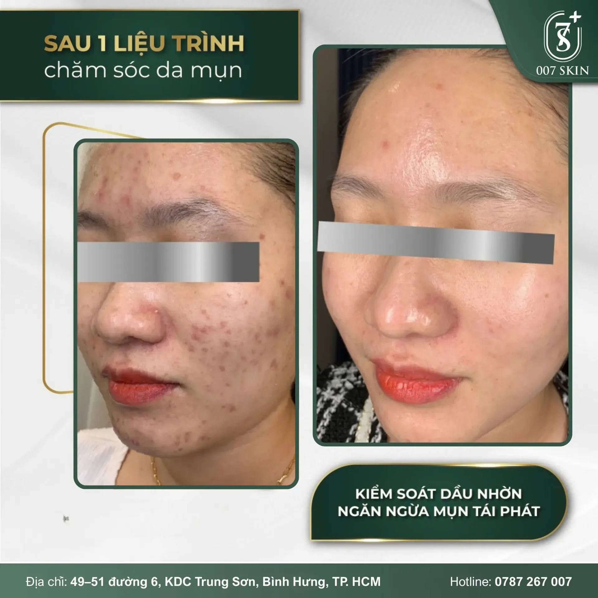 Hình ảnh before – after thực tế của khách hàng sau 1 liệu trình chăm sóc da mụn tại 007 SKIN