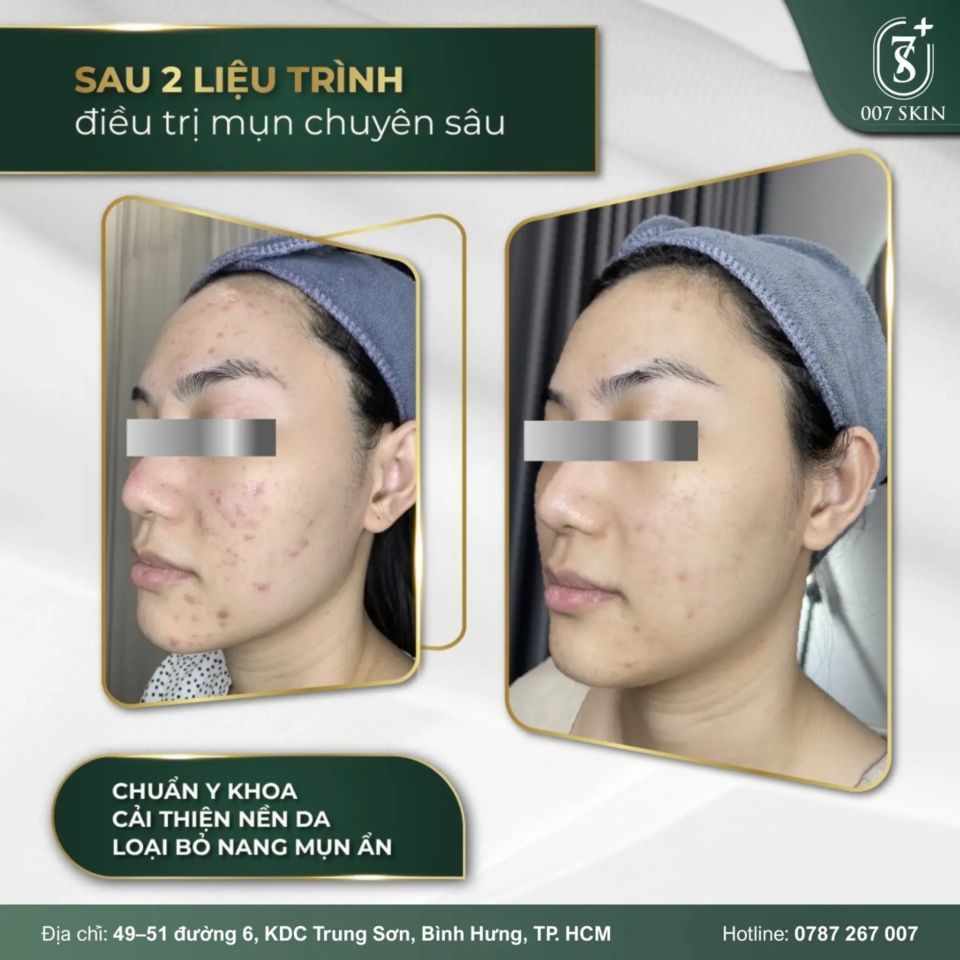 Hình ảnh trước – sau thực tế của khách hàng sau 2 liệu trình điều trị mụn chuyên sâu tại 007 SKIN
