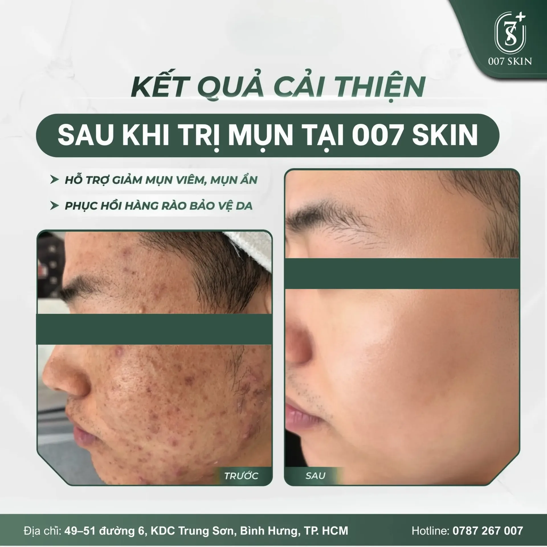 KẾT QUẢ CẢI THIỆN RÕ RỆT SAU KHI TRỊ MỤN TẠI 007 SKIN