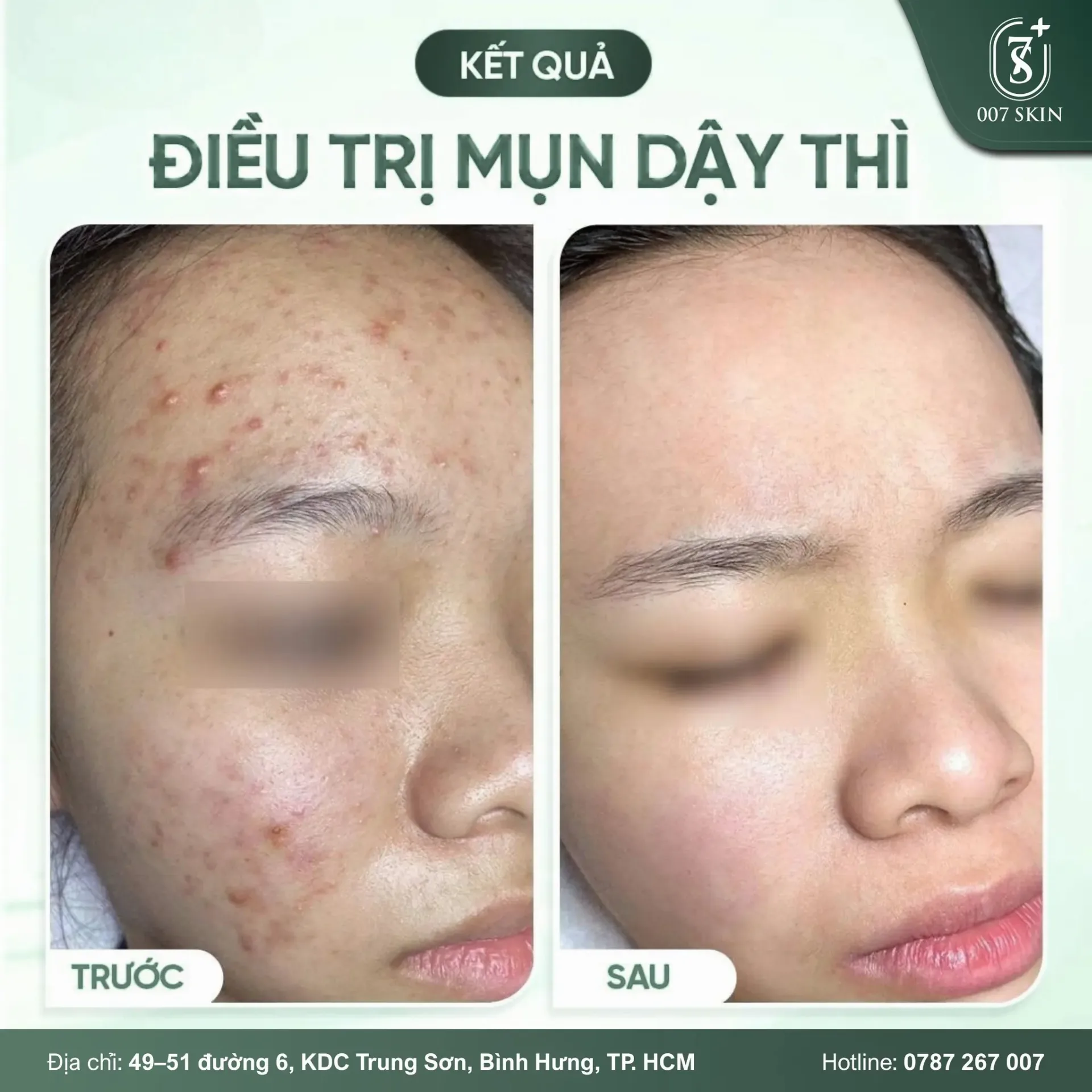 KẾT QUẢ ĐIỀU TRỊ MỤN DẬY THÌ – DA THAY ĐỔI RÕ RỆT