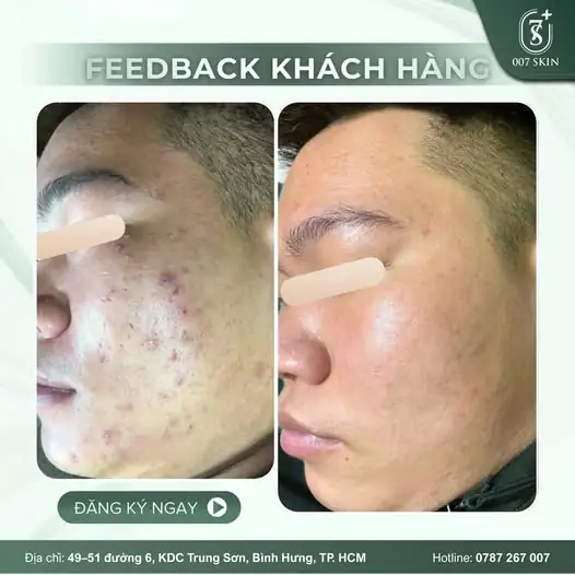 KẾT QUẢ THẬT – GIÁ TRỊ THẬT: TẠM BIỆT NỖI LO VỀ MỤN!