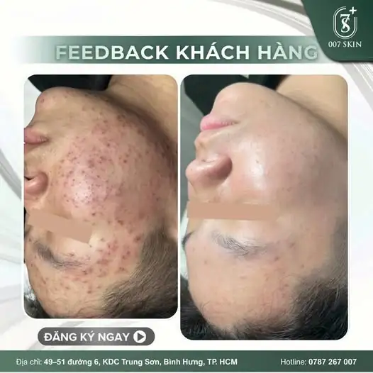 Kết quả thực tế từ khách hàng chính là lời khẳng định uy tín nhất của 007 Skin.